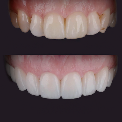 Case 2
Discoloration Of The Anterior Maxilla
