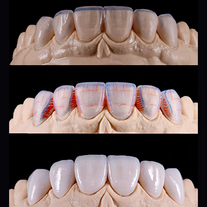 #anterior crowns
