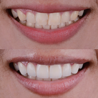 Case 5
Discoloration Of The Anterior Maxilla