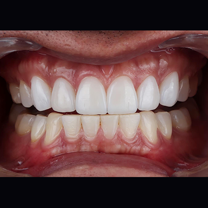 #upper veneers