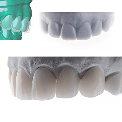 Case 3
Discoloration In The Anterior
Maxillary & Mandibular Teeth