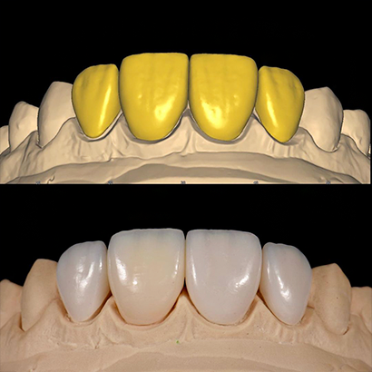 # anterior crowns