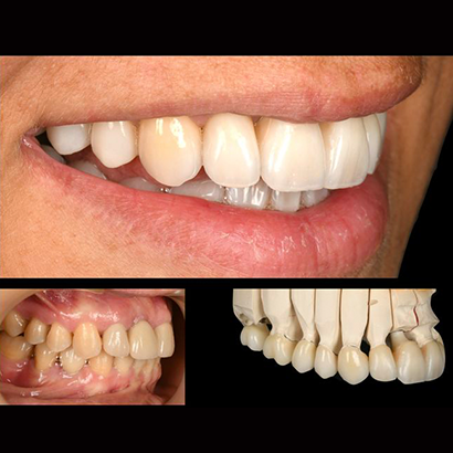 # upper crowns & veneers