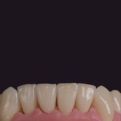 Case 2
Full Arch Spacing & Malalignment