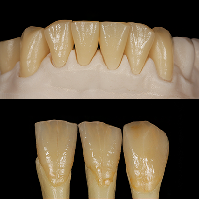 Case 1  
Lower Jaw #33–43