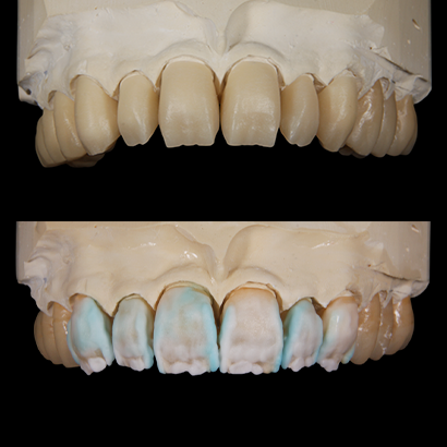 Case 1 
Upper Jaw #17–27
