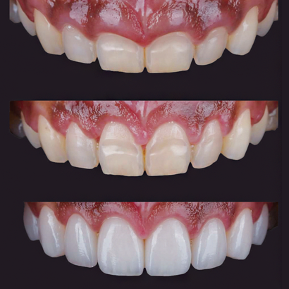 Case 1
Management Of Gummy Smile In The Anterior Maxilla