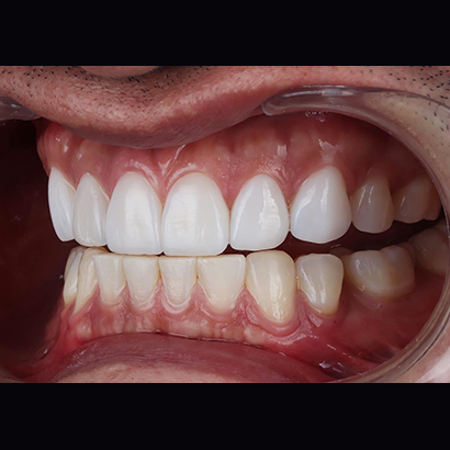 #upper veneers