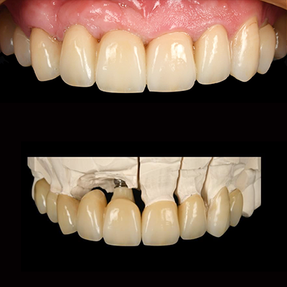 # veneers & crowns