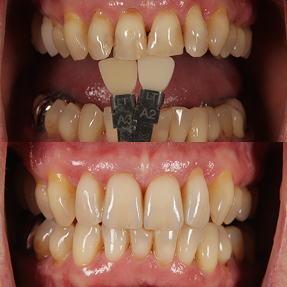 Case 2
Upper Jaw #12–22