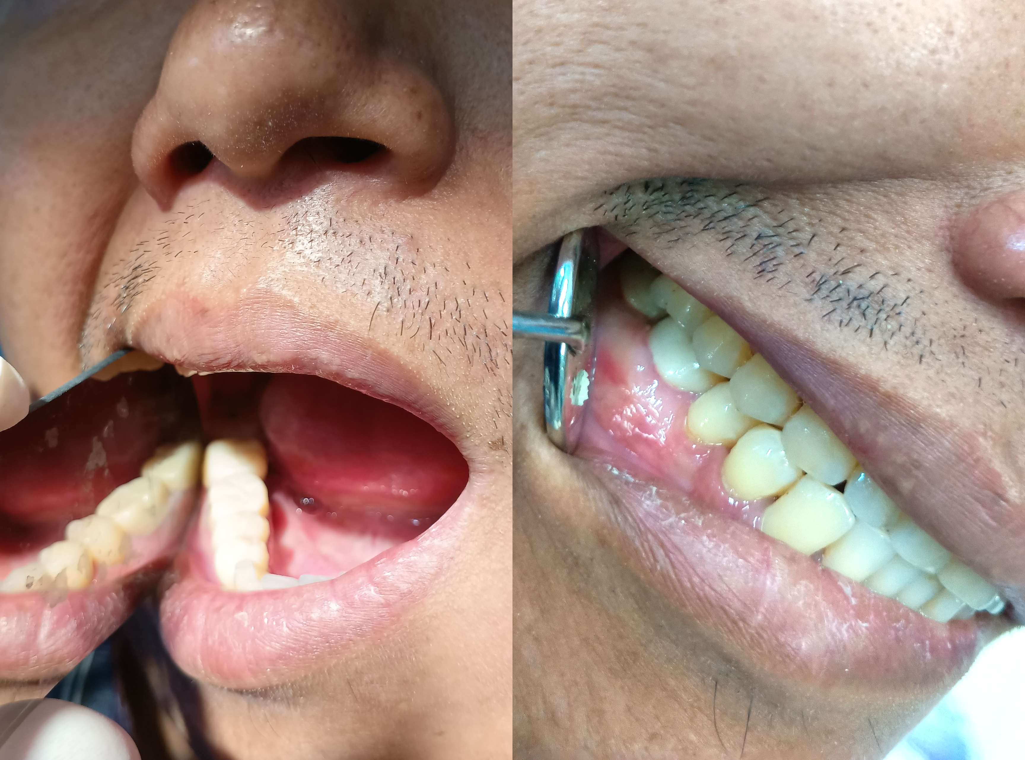 HASS Expands Support Initiatives in Cambodia with Hands-On Training for Local Dental Technician