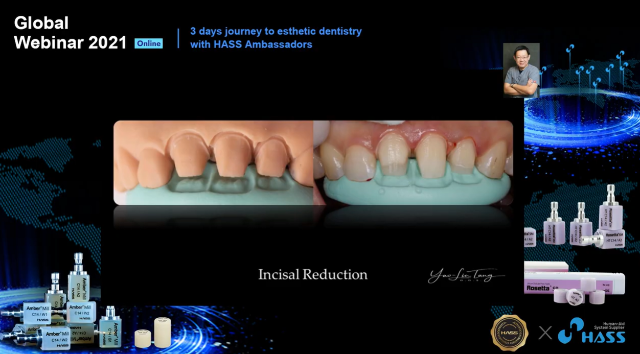 [AM-Webinar] Clinical Pearls : Amber Mill's Anterior Crowns/Veneers Preparation