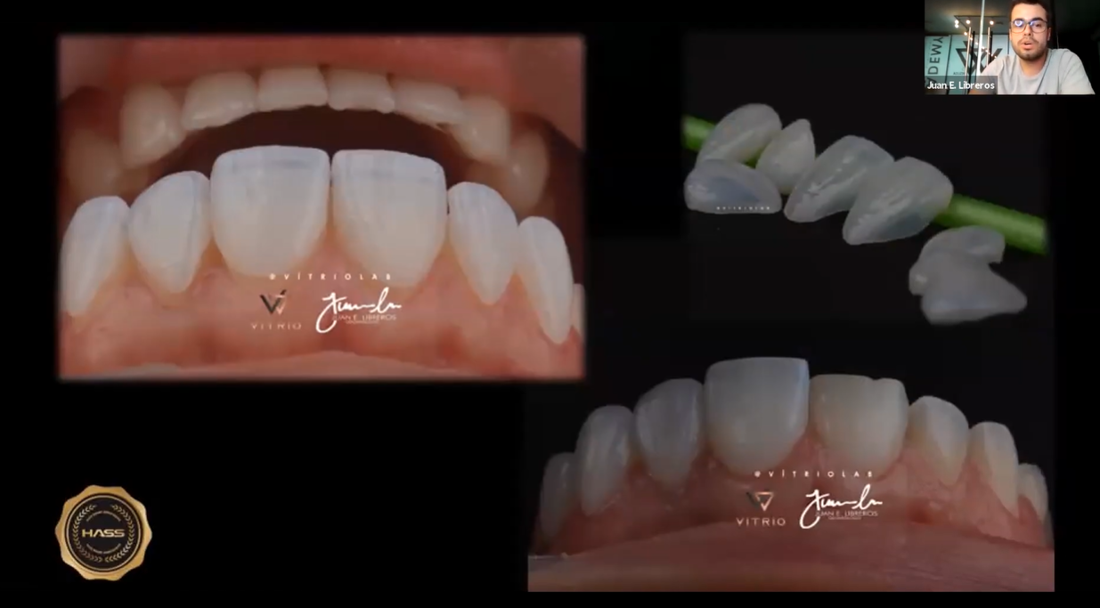 [AM-Webinar] InOffice Veneers - Inside the Lab