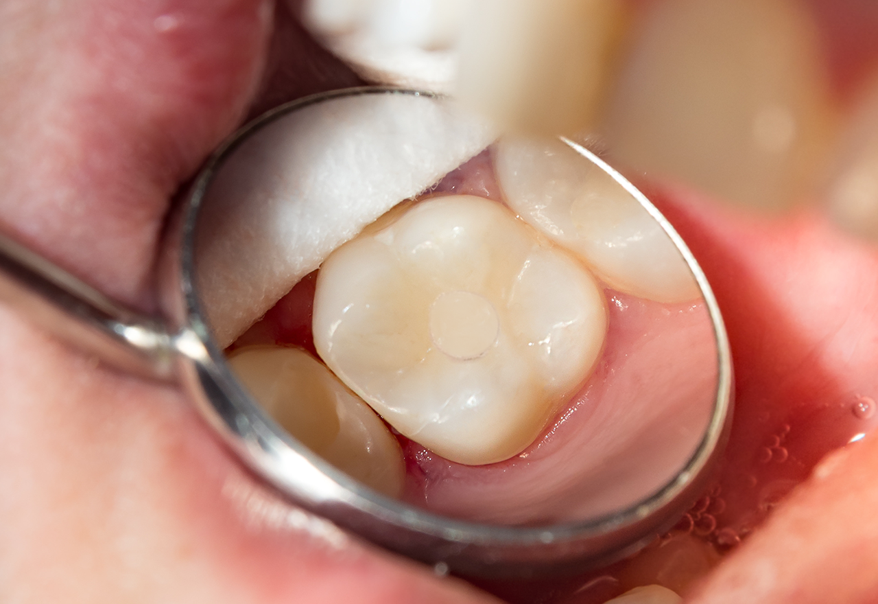 Hole keeper